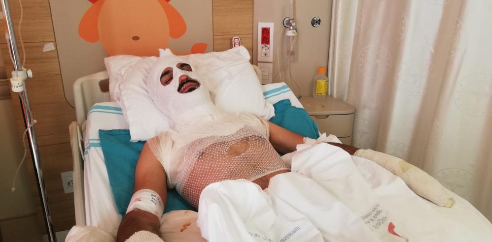 Isınmak için tenekeye tiner atınca elinde ve yüzünde yanıklar oluştu